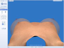 Digital Breast Augmentation