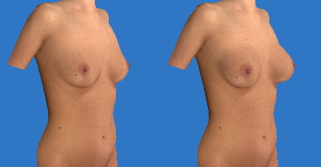 VECTRA 3D Scarless Virtual Breast Augmentation