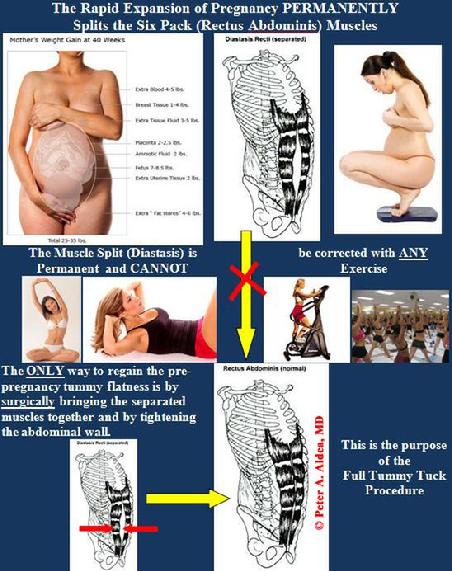 Tummy Tuck, Memphis, TN, Plastic Surgery