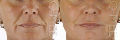 Memphis Plastic Surgery,lips,Restylane,Dr. Aldea,Dr. Eby