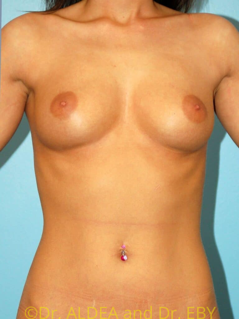 Before Image: Breast Augmentation #530 - front