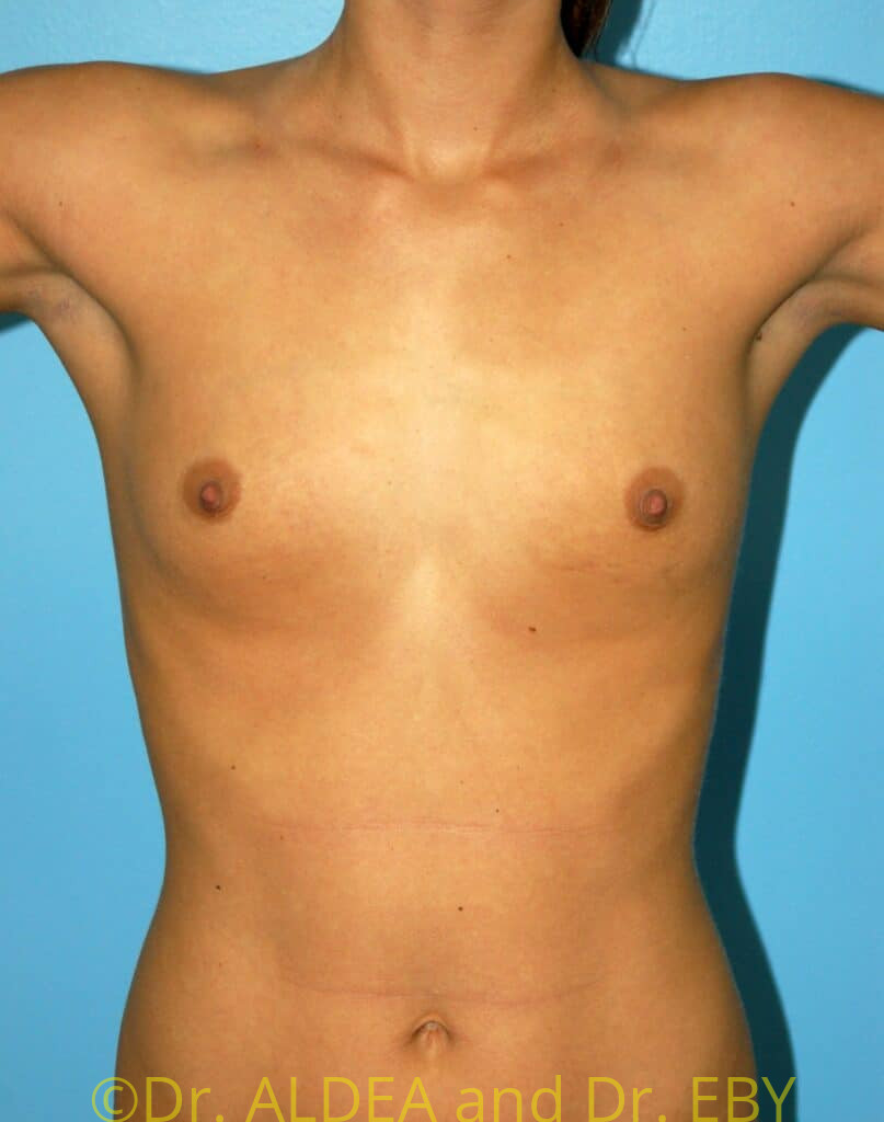 Before Image: Breast Augmentation #857 - front