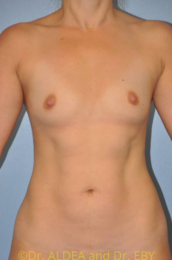 Before Image: Breast Augmentation #195 - front