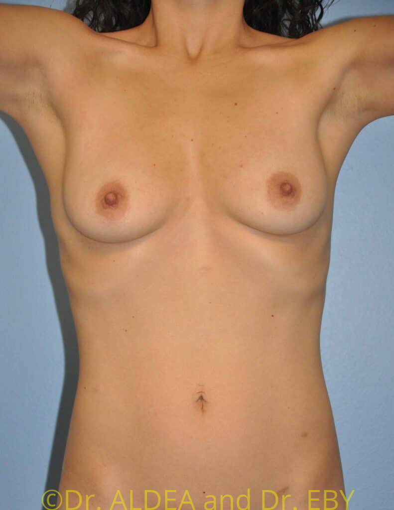 Before Image: Breast Augmentation #231 - front