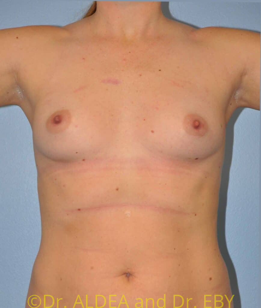 Before Image: Breast Augmentation #298 - front