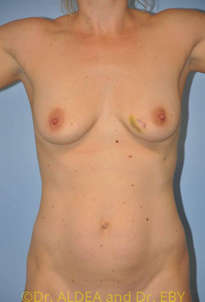 Before Image: Breast Augmentation #456 - front