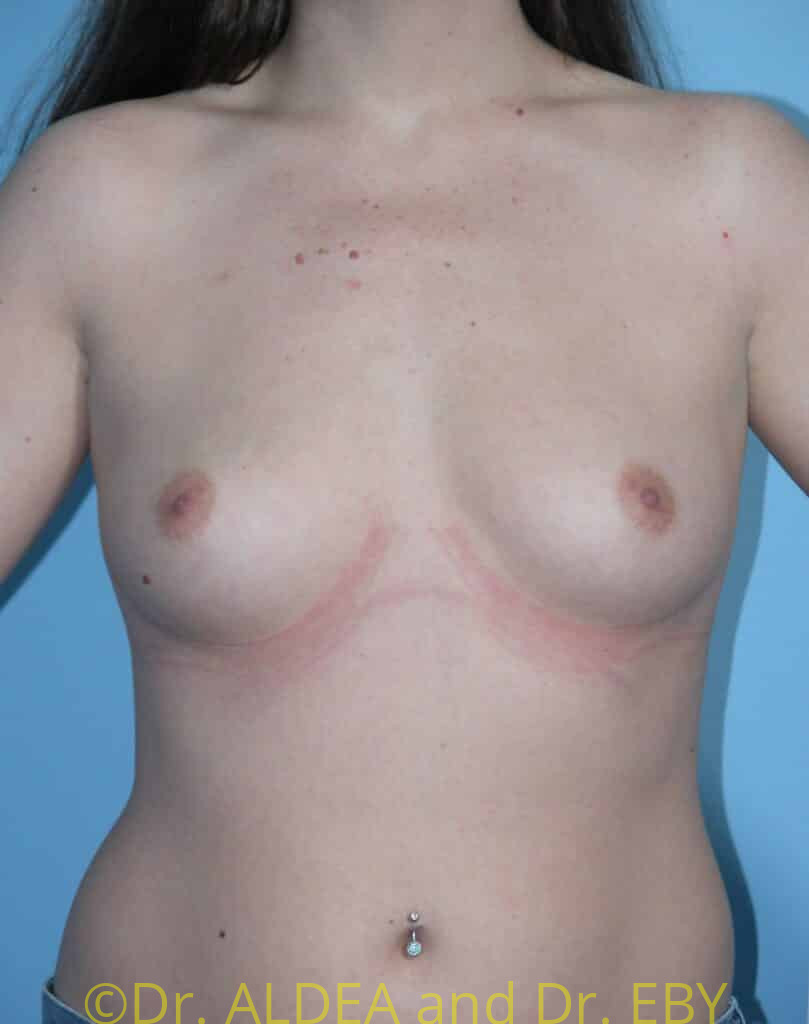 Before Image: Breast Augmentation #620 - front