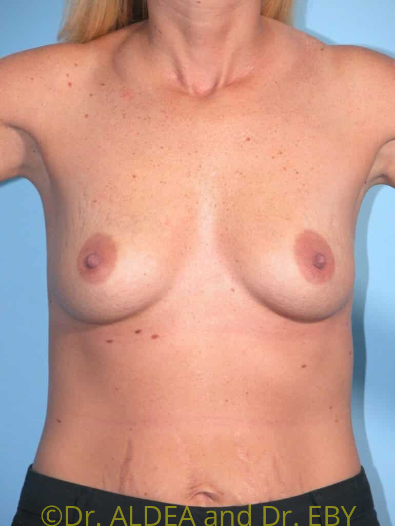 Before Image: Breast Augmentation #753 - front