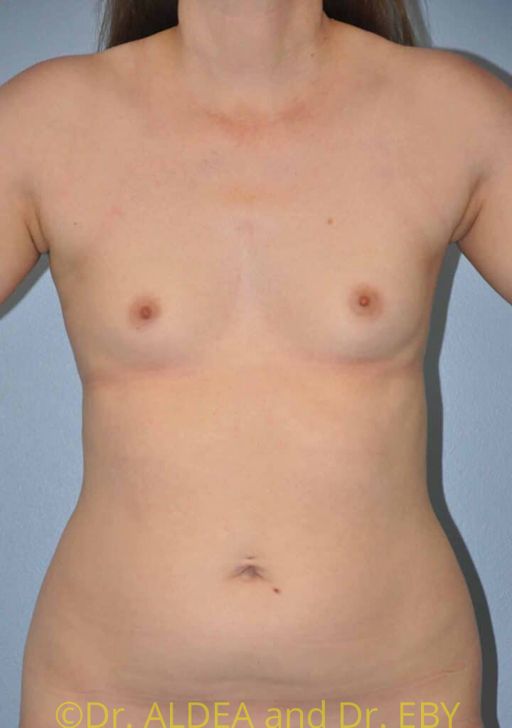 Before Image: Breast Augmentation #440 - front