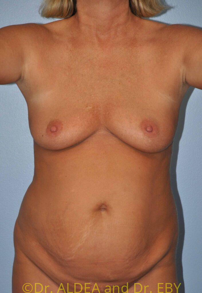 Before Image: Breast Augmentation #354 - front