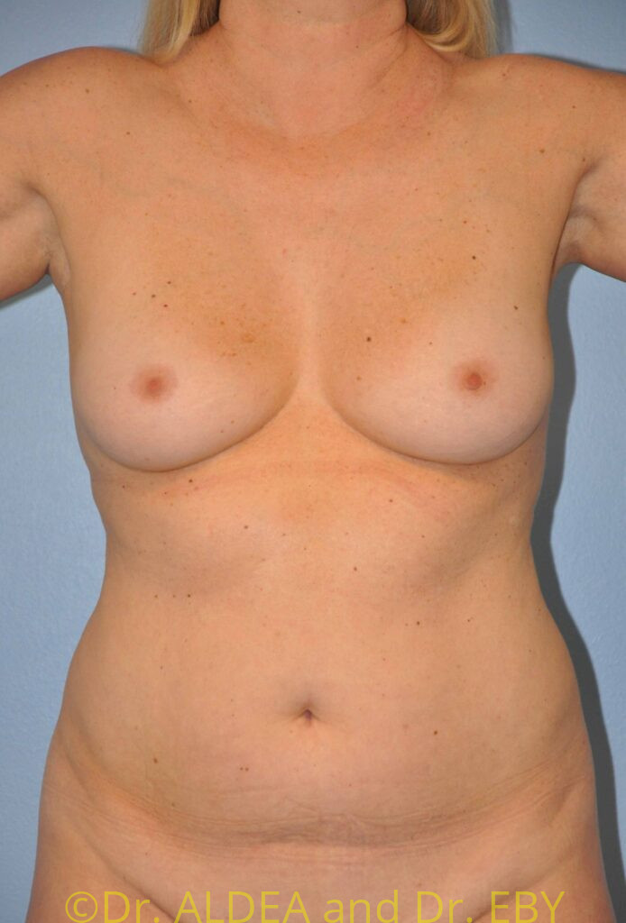 Before Image: Breast Augmentation #599 - front