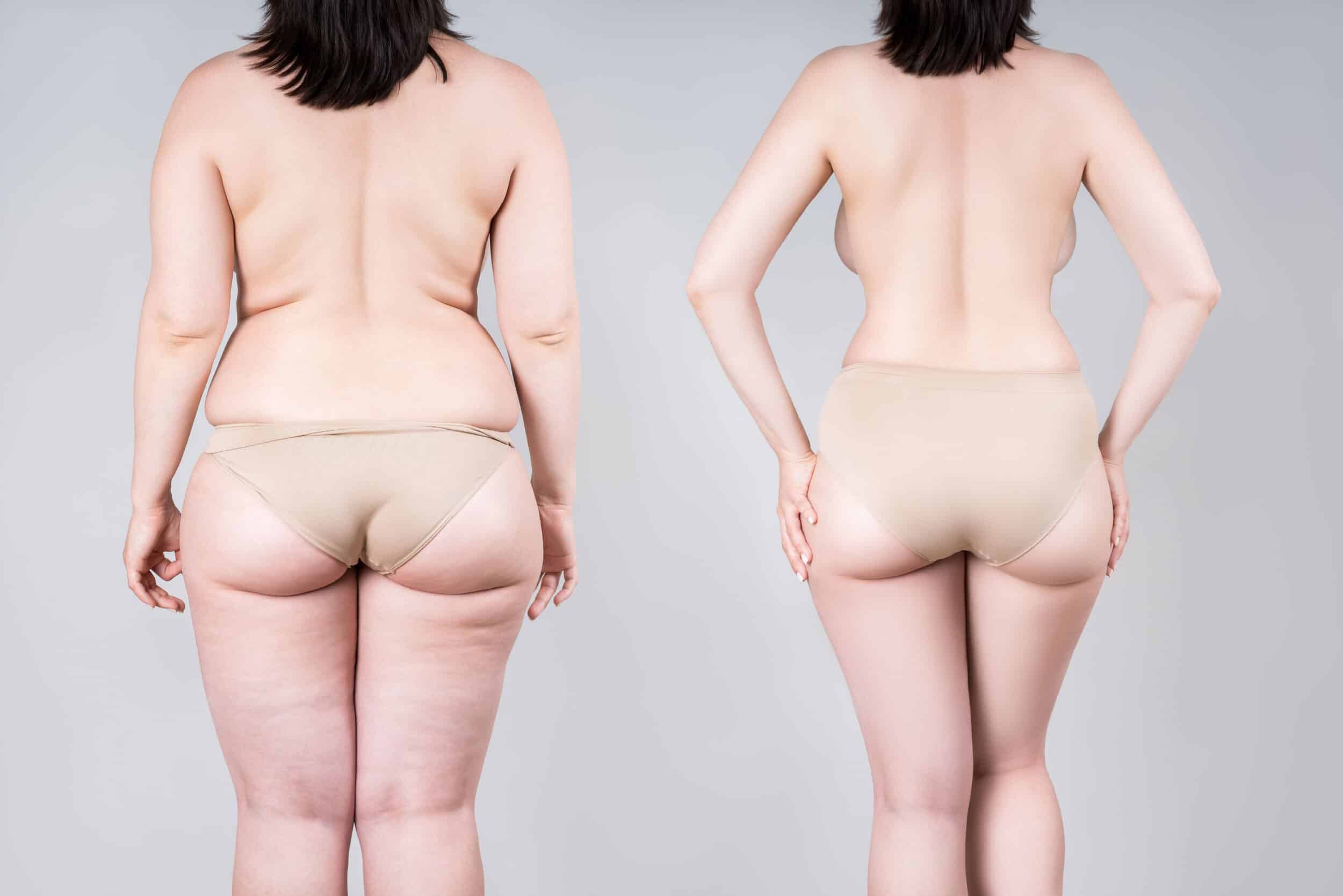 ALDEA-Liposuction-Large-RED-_2194993471