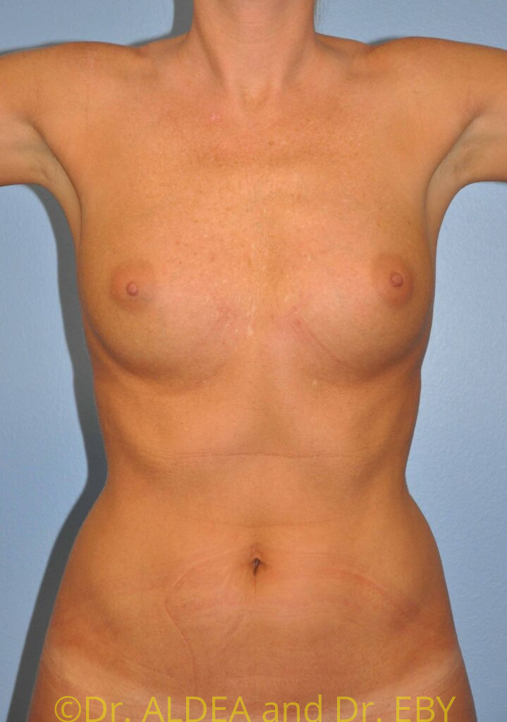 Before Image: Breast Augmentation #151 - front