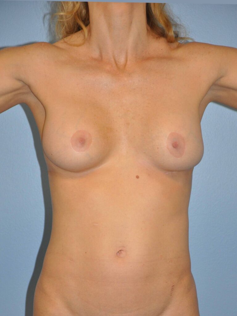 Before Image: Breast Implant Removal (Explantation) WITHOUT Lift #569 - front