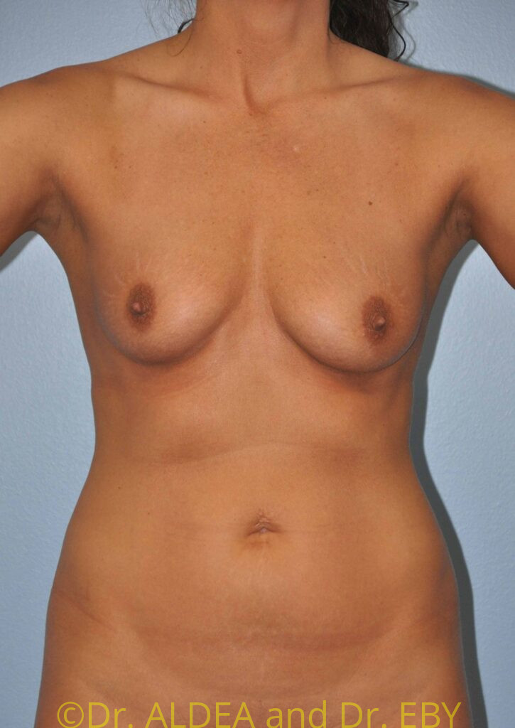 Before Image: Breast Augmentation #948 - front