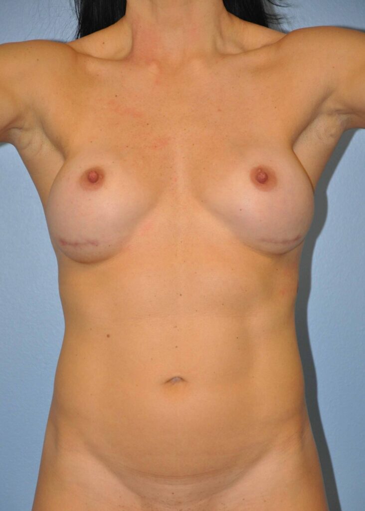 Before Image: Breast Implant Exchange #855 - front