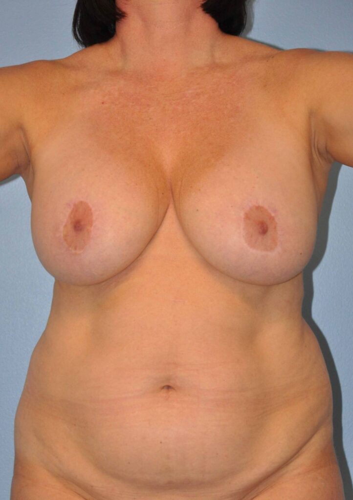 Before Image: Breast Implant Removal (Explantation) WITH a Lift #272 - front