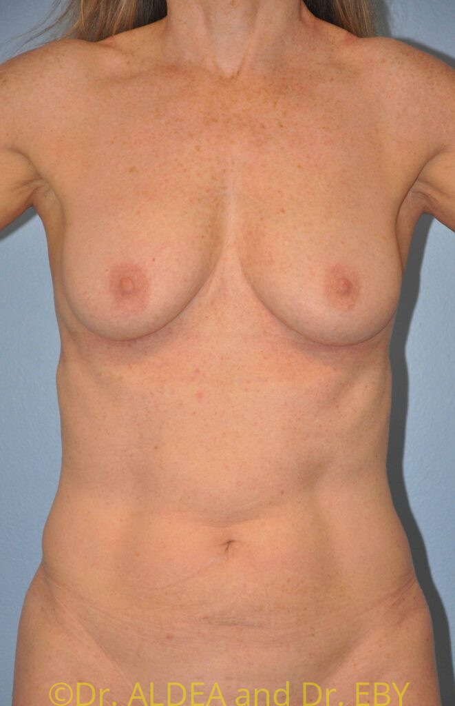 Before Image: Breast Augmentation #294 - front