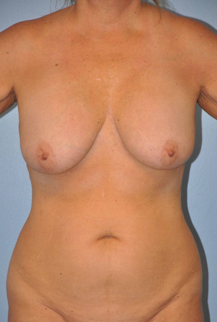 Before Image: Breast Implant Exchange with Lift #276 - front