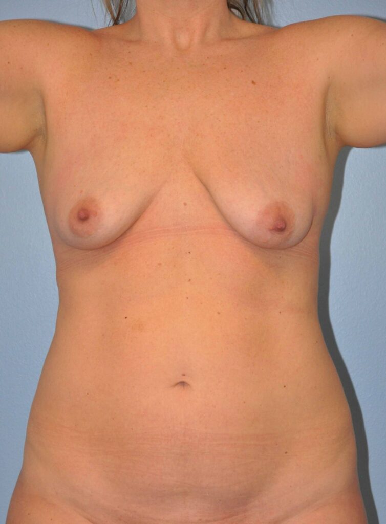 Before Image: Breast Implant Removal (Explantation) WITH a Lift #346 - front