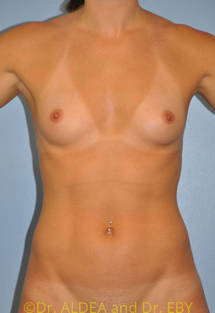 Before Image: Breast Augmentation #078 - front
