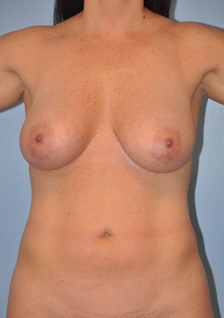 Before Image: Breast Implant Exchange with Lift #334 - front