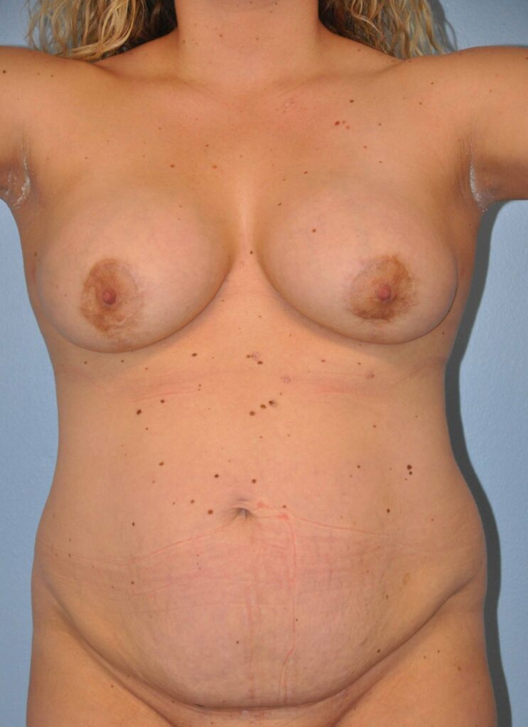 Before Image: Breast Implant Removal (Explantation) WITH a Lift #897 - front