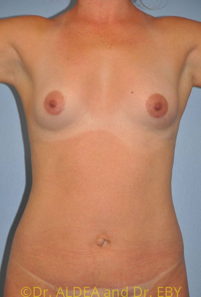 Before Image: Breast Augmentation #255 - front