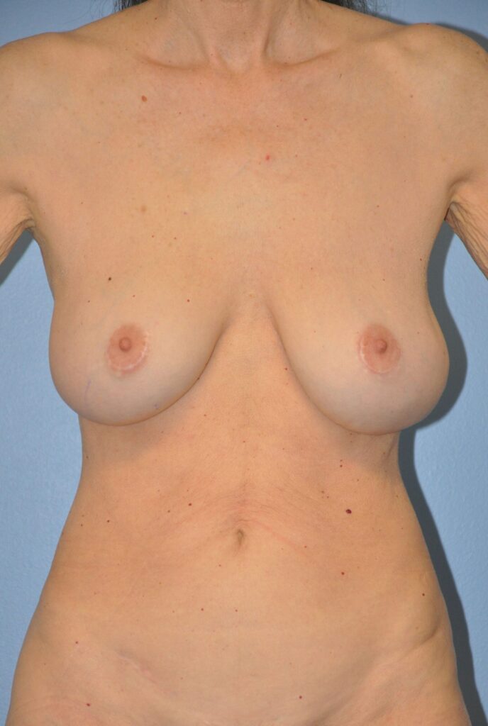 Before Image: Breast Implant Exchange with Lift #953 - front