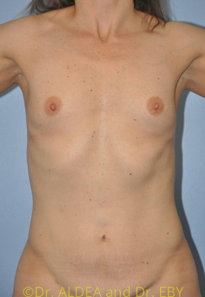 Before Image: Breast Augmentation #437 - front