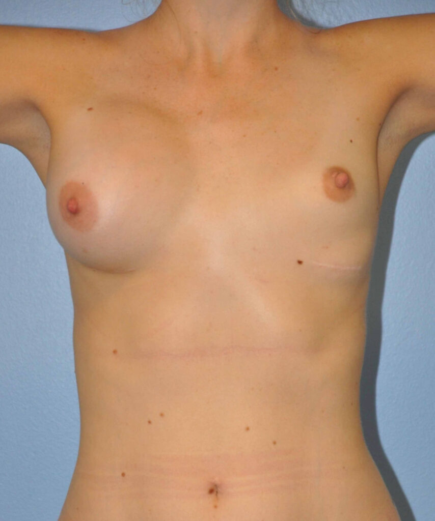 Before Image: Breast Implant Exchange with Lift #858 - front