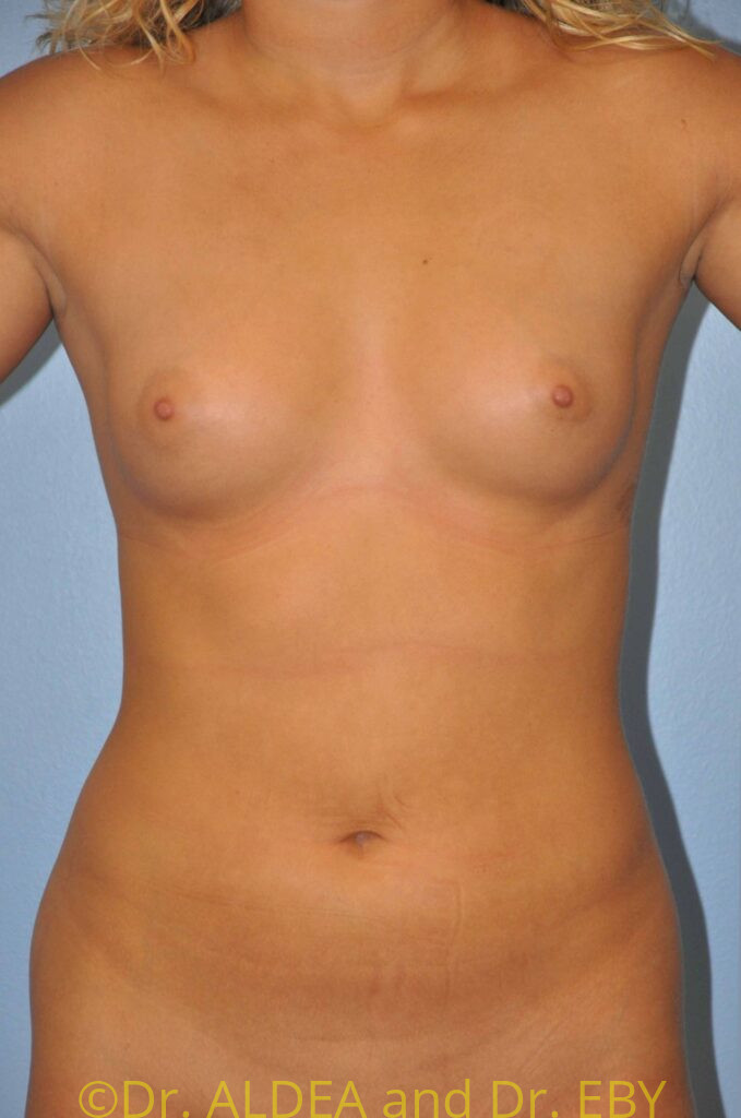 Before Image: Breast Augmentation #657 - front