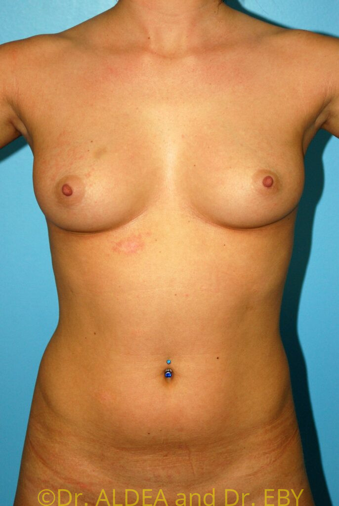 Before Image: Breast Augmentation #714 - front