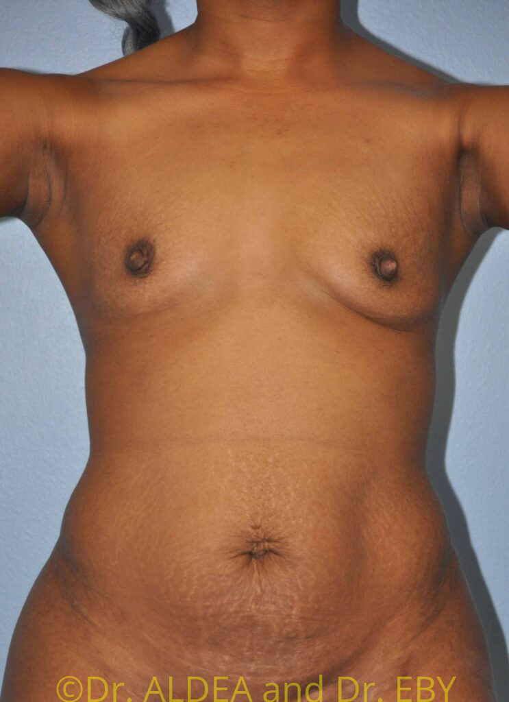 Before Image: Breast Augmentation #727 - front