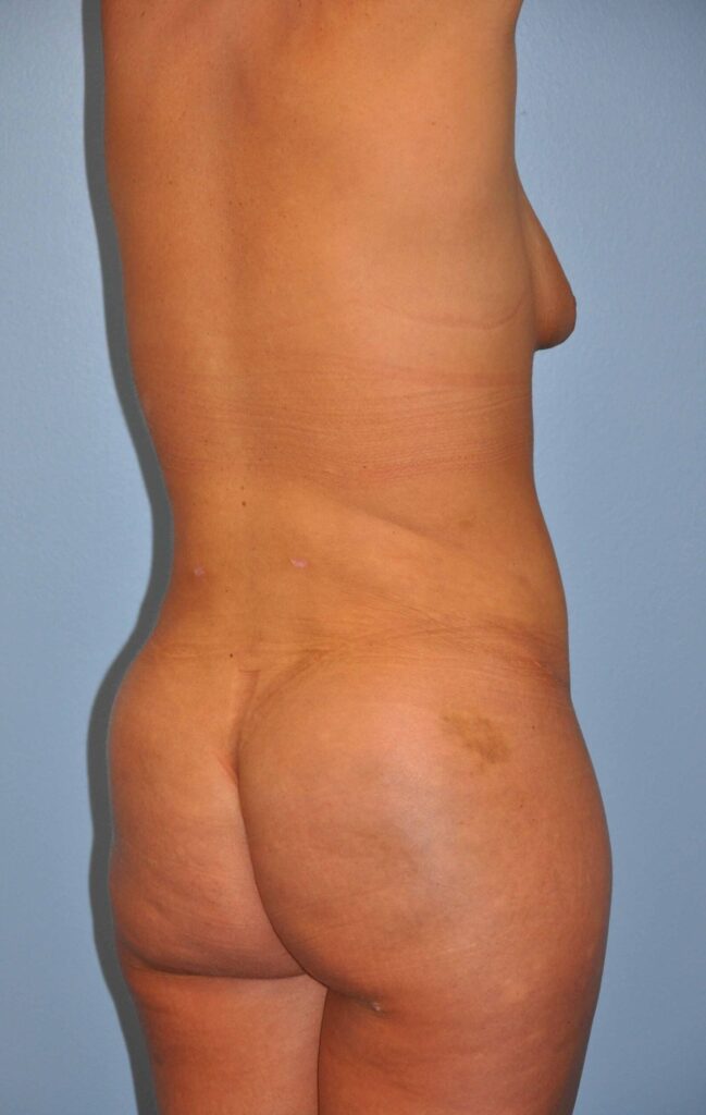 After Image: Precision BBL #805 - right-back-oblique