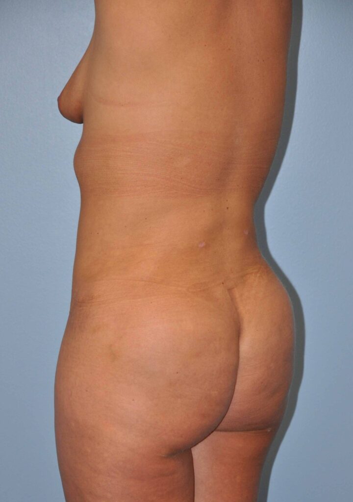 After Image: Precision BBL #805 - left-back-oblique