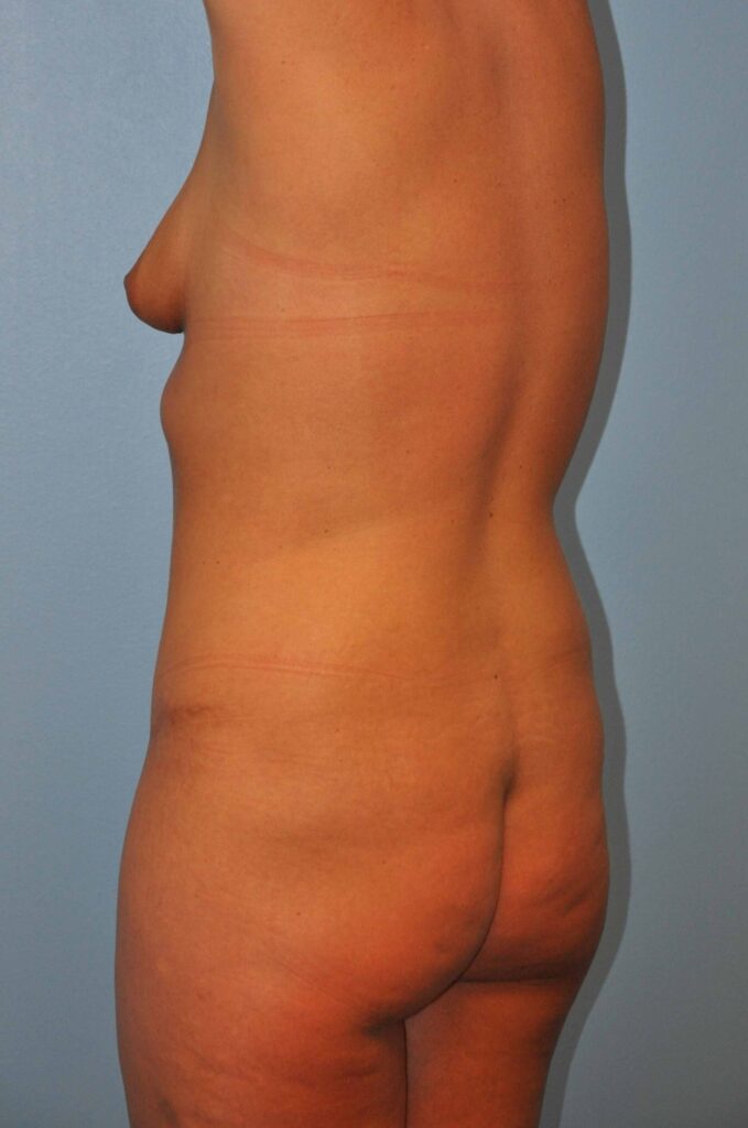 Before Image: Precision BBL #805 - left-back-oblique