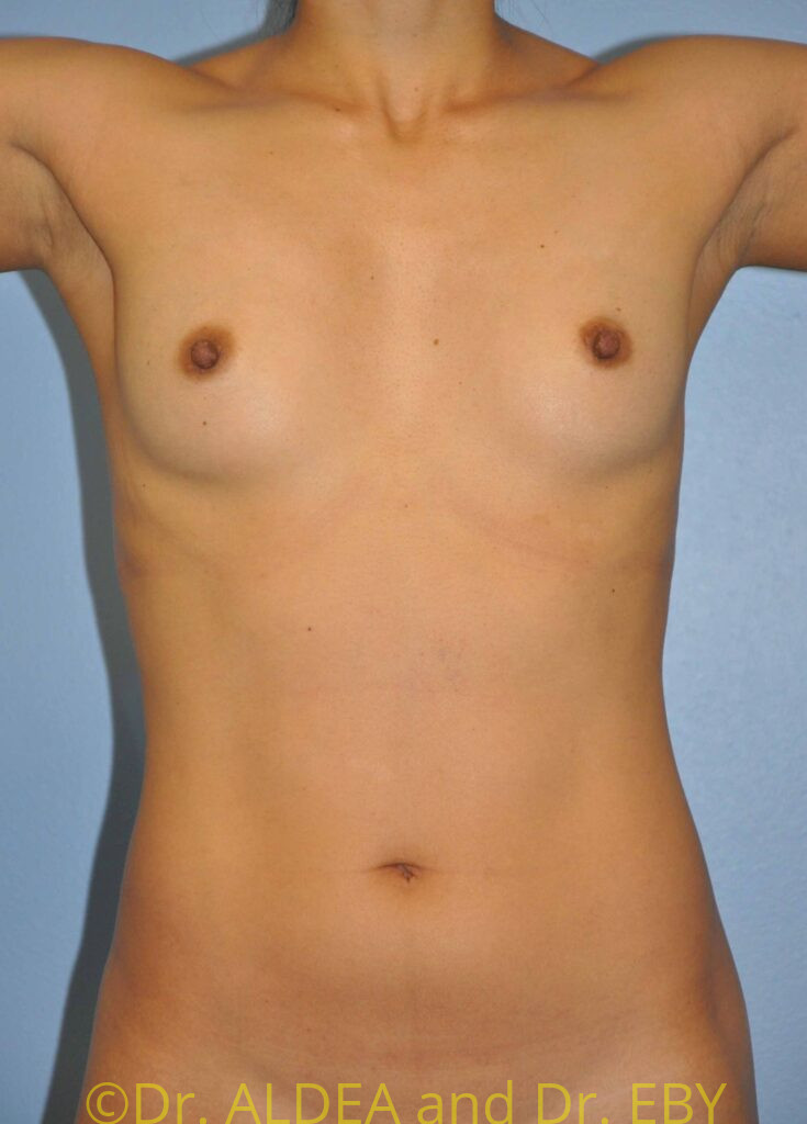 Before Image: Breast Augmentation #875 - front