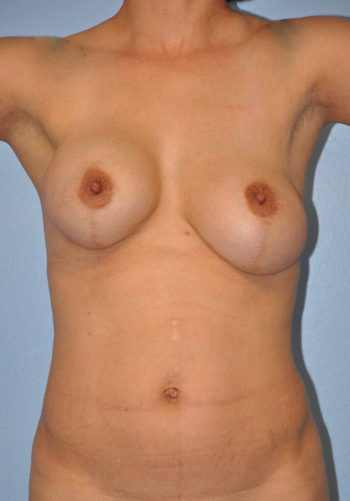 Before Image: Breast Implant Exchange with Lift #513 - front