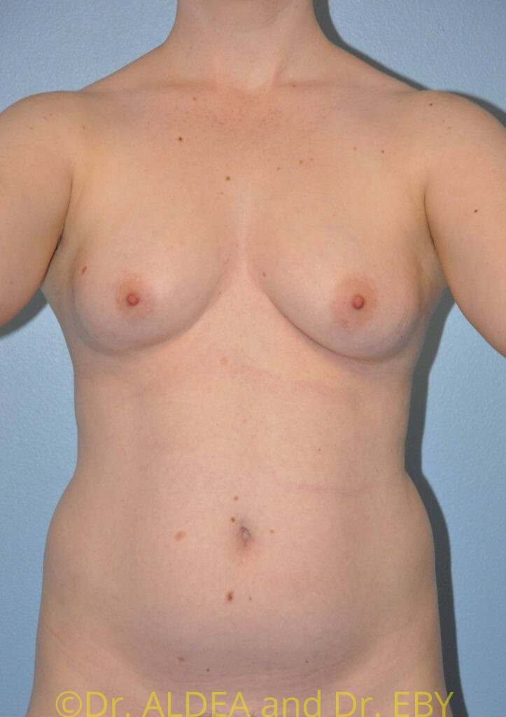 Before Image: Breast Augmentation #936 - front