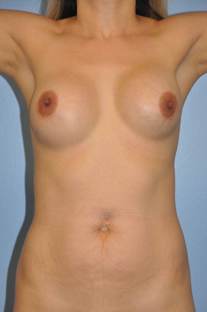 Before Image: Breast Implant Exchange #567 - front