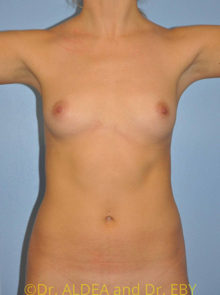 Before Image: Breast Augmentation #499 - front