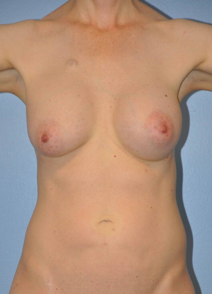 Before Image: Breast Implant Removal (Explantation) WITHOUT Lift #836 - front