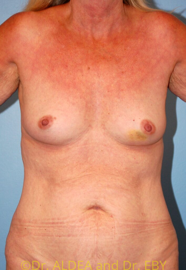 Before Image: Breast Augmentation #944 - front