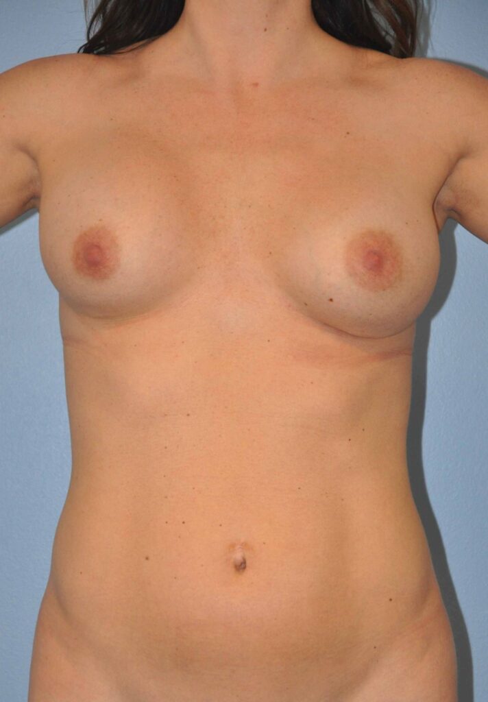Before Image: Breast Implant Exchange #625 - front