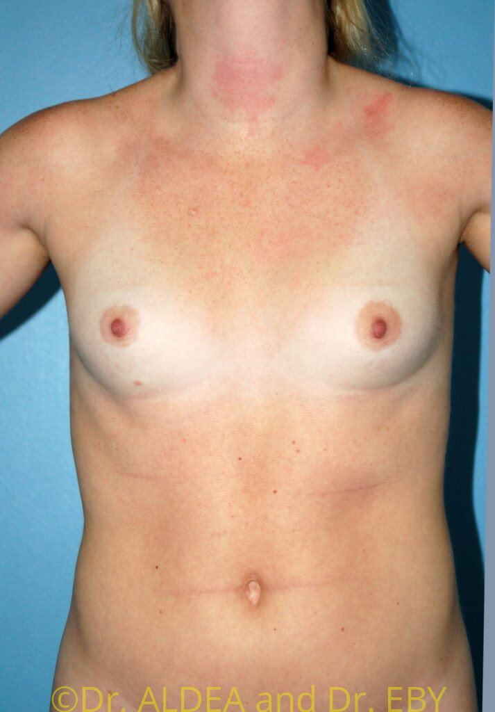 Before Image: Breast Augmentation #281 - front