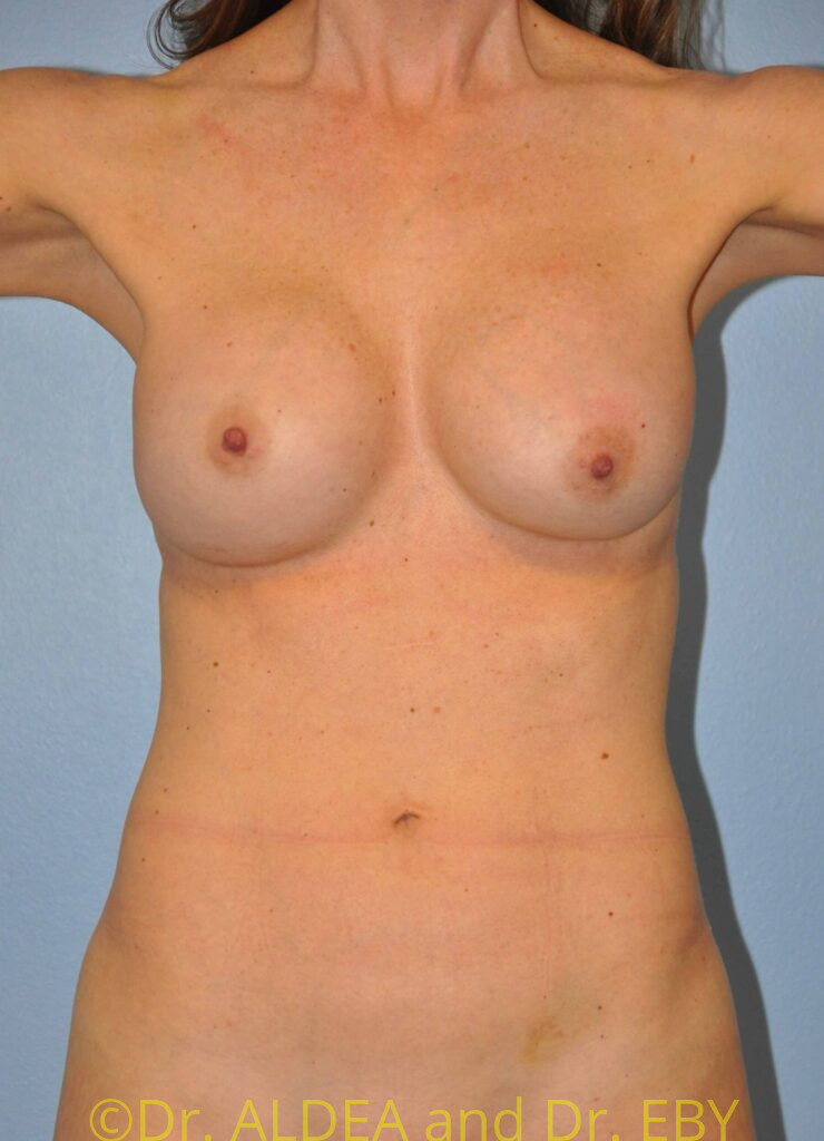Before Image: Breast Implant Exchange #978 - front