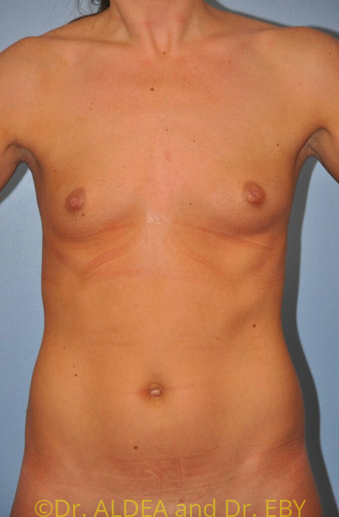 Before Image: Breast Augmentation #395 - front