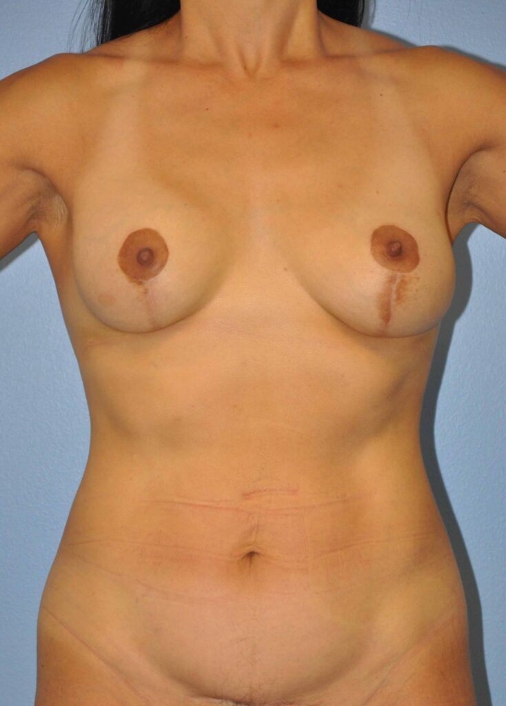 Before Image: Breast Implant Exchange with Lift #469 - front