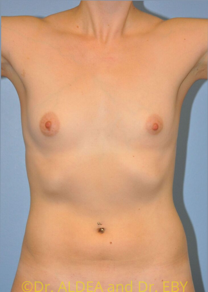 Before Image: Breast Augmentation #543 - front
